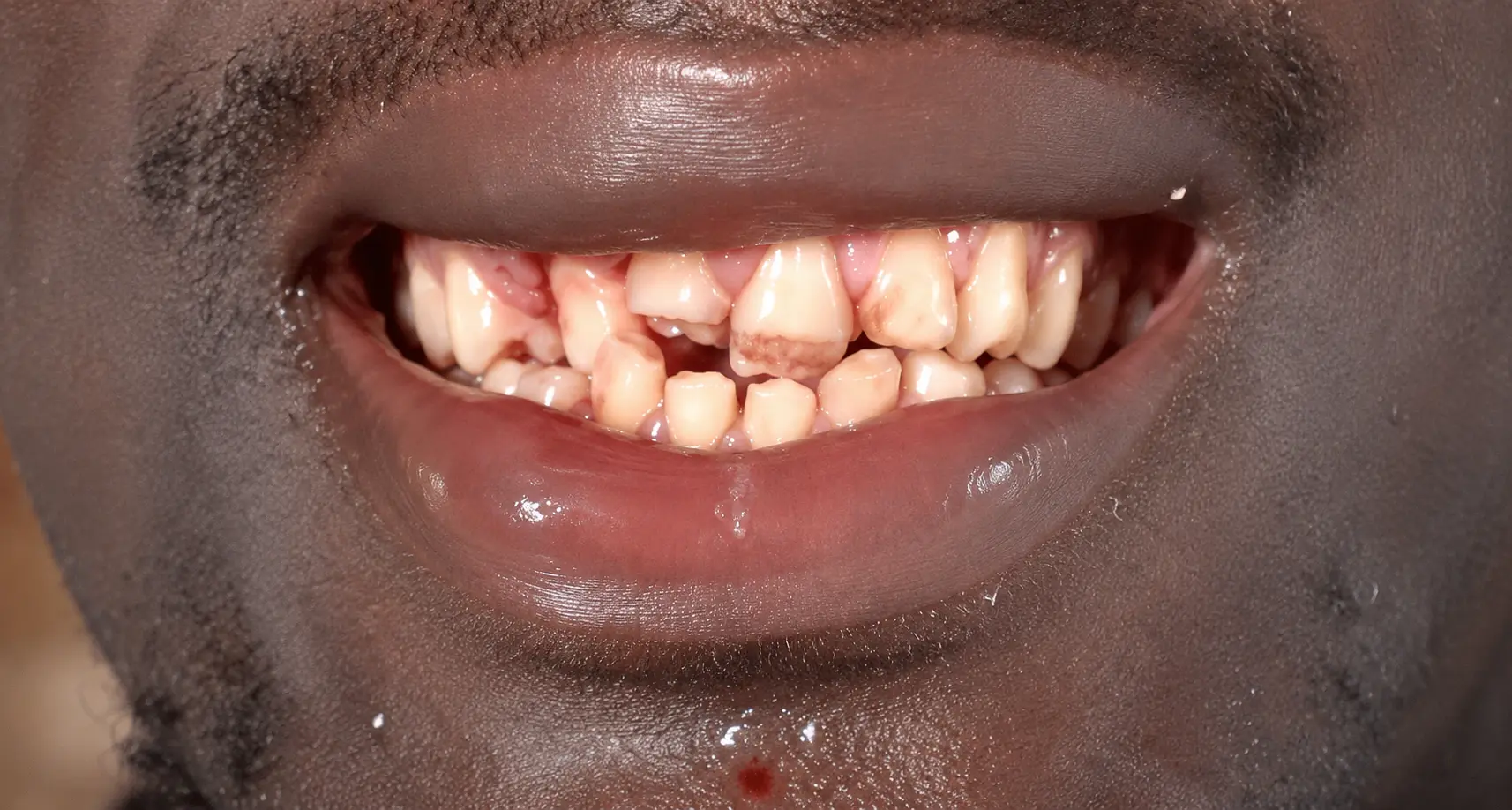 From Emergency Dental Trauma Care to RCT, Crowns and Veneers before treatment – WhiteLine Dental Clinic Al Rigga
