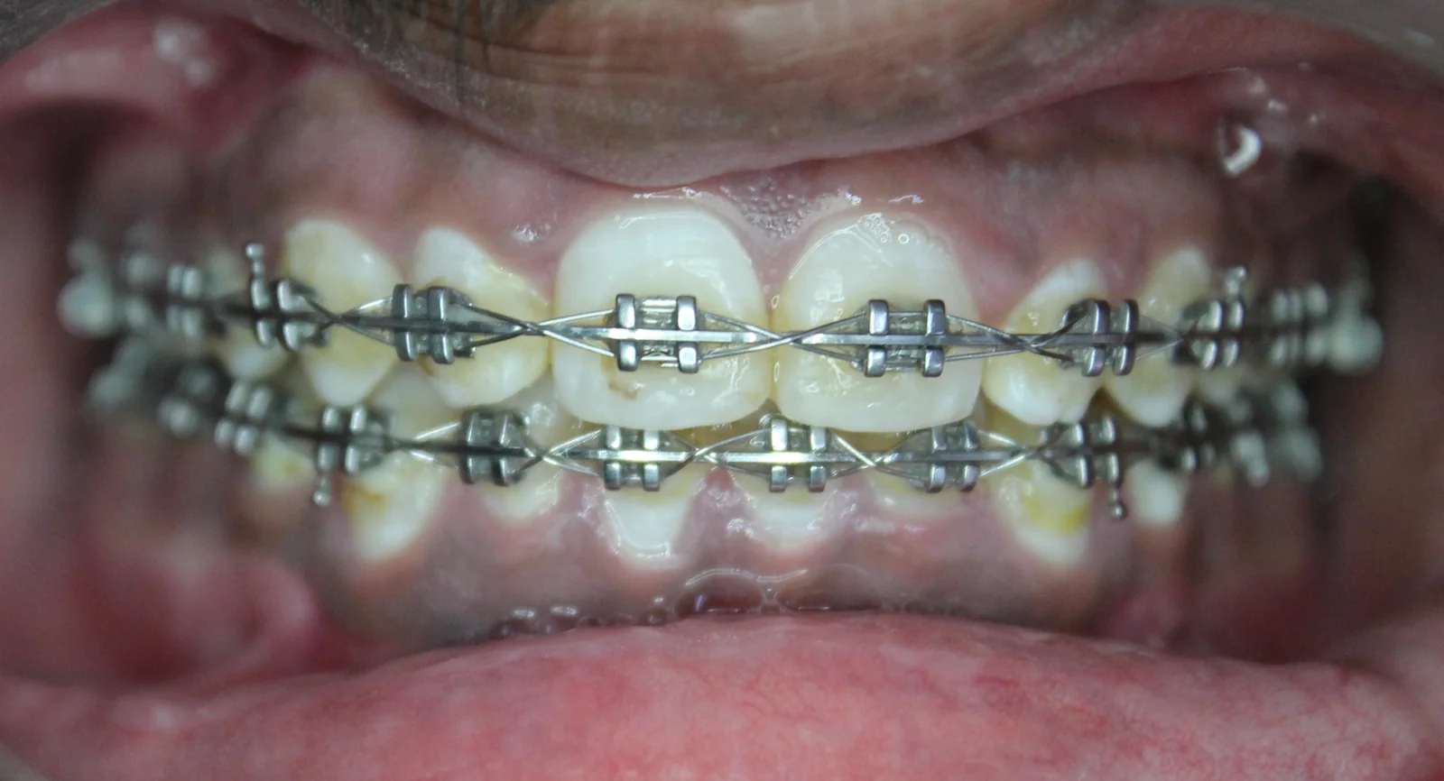Braces Treatment – Case 1 after treatment at WhiteLine Dental Clinic Al Rigga