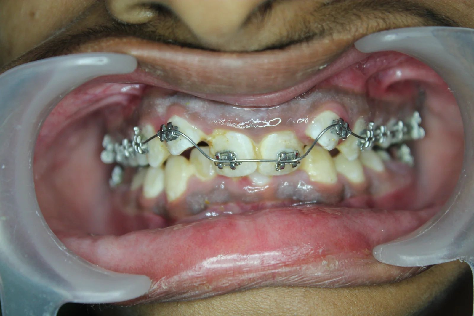 Braces Treatment – Case 1 before treatment – WhiteLine Dental Clinic Al Rigga