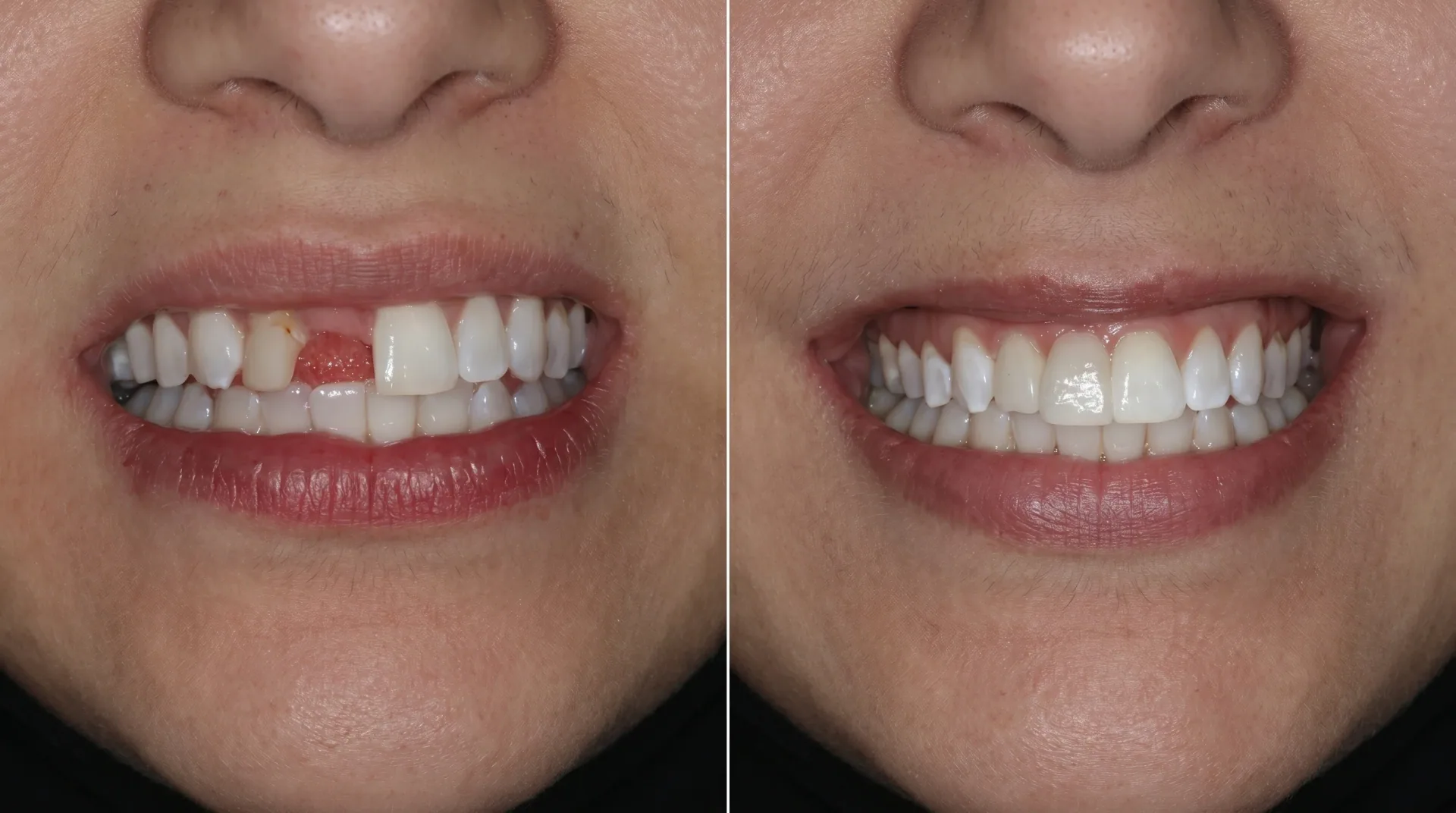 Dental bridge results at WhiteLine Dental Clinic Al Rigga