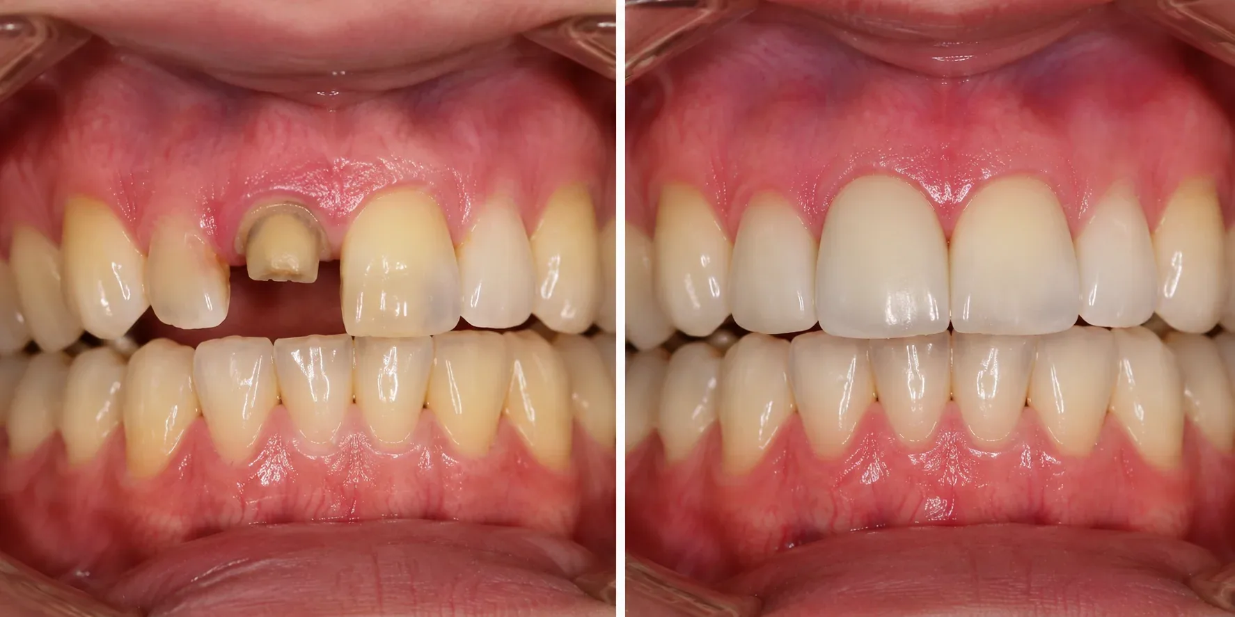 Dental crown results at WhiteLine Dental Clinic Al Rigga