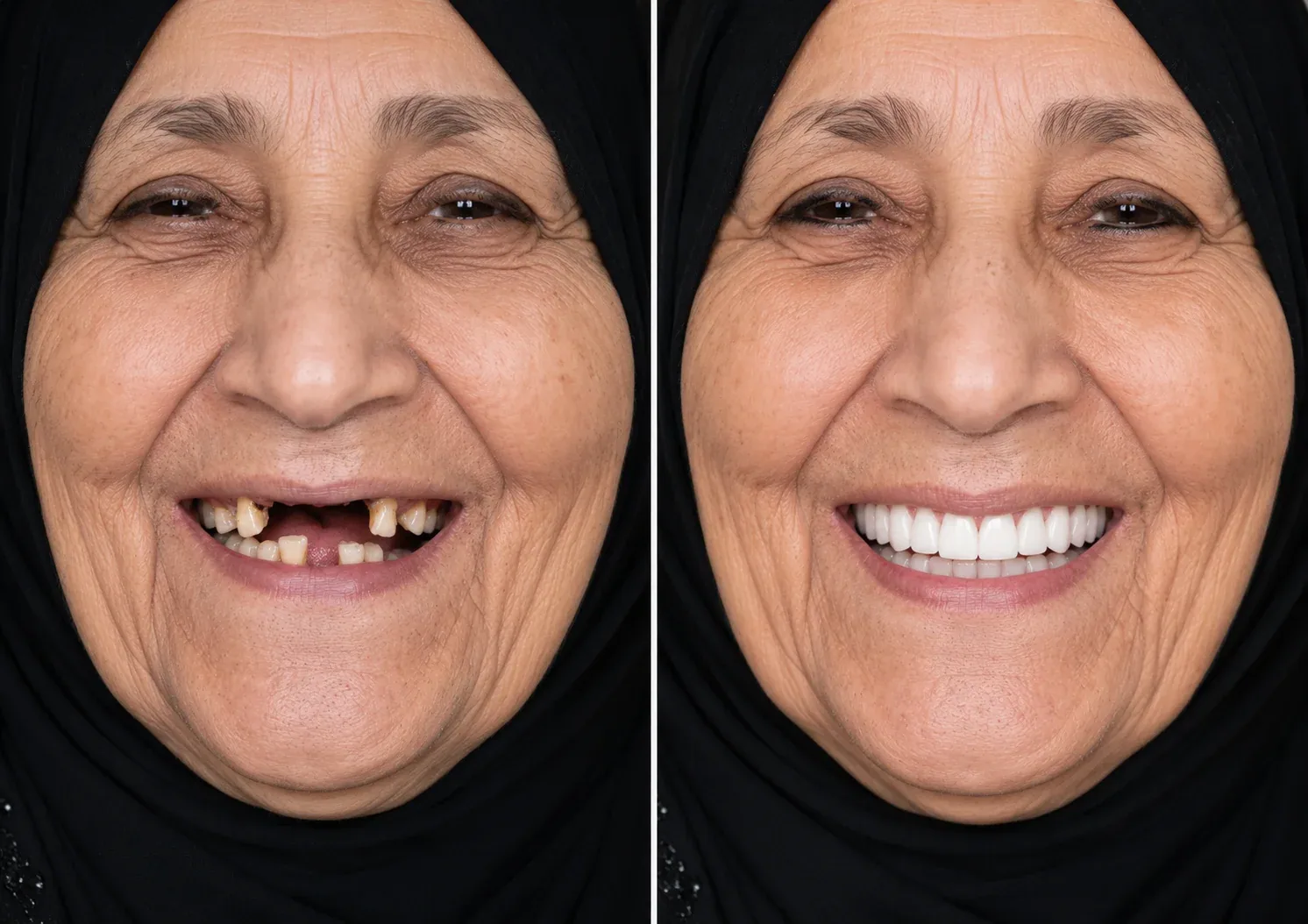 Denture results at WhiteLine Dental Clinic Al Rigga