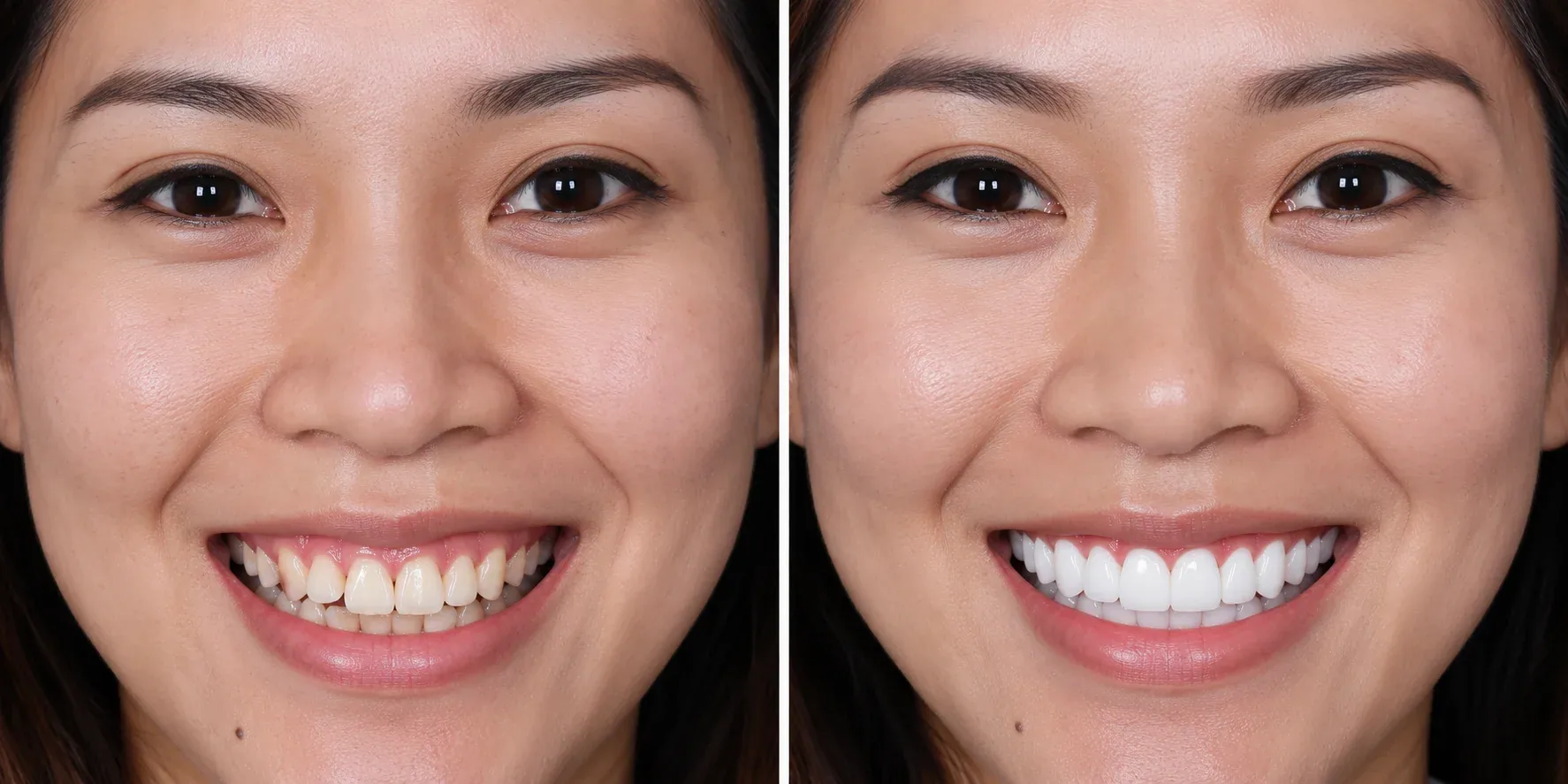 Hollywood Smile transformation at WhiteLine Dental Clinic Al Rigga