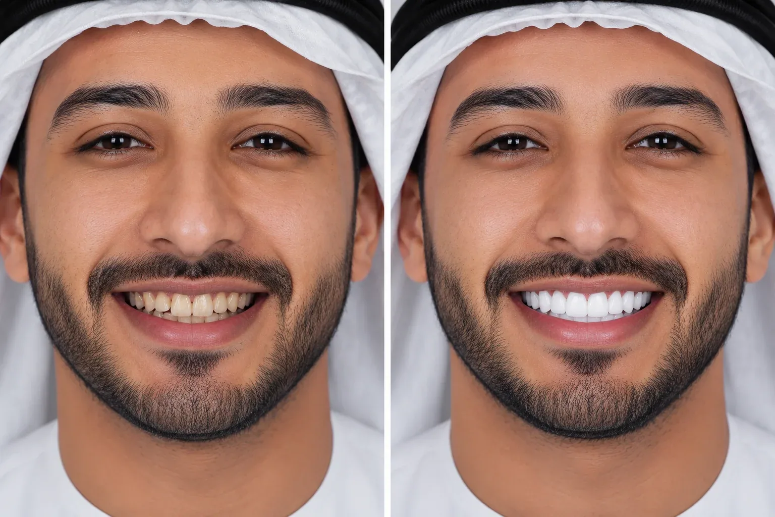 Hollywood Smile transformation at WhiteLine Dental Clinic Al Rigga