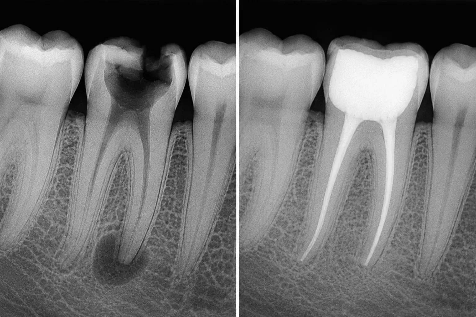 Root canal treatment results at WhiteLine Dental Clinic Al Rigga
