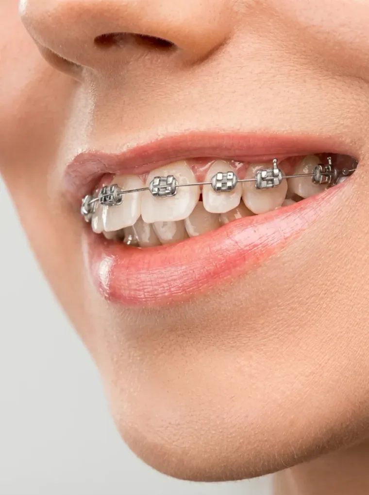 Teeth Braces treatment at WhiteLine Dental Clinic Al Rigga